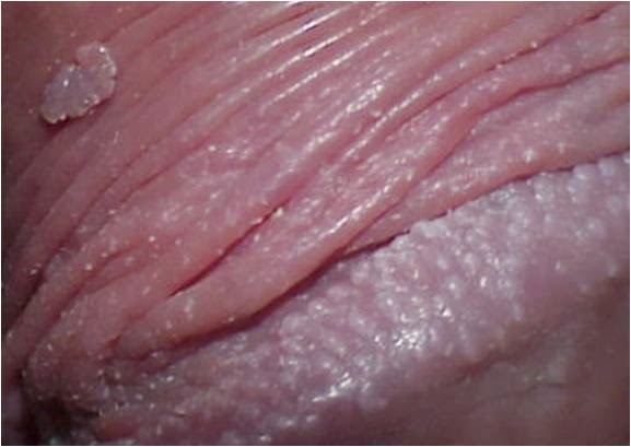 como se manifiesta el virus del papiloma humano en los hombres como se manifiesta el virus del papiloma humano en los hombres